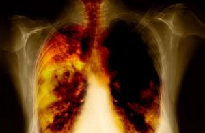 Tumore al polmone, diagnosi veloce con un semplice test del sangue
