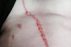 Un ragno sotto pelle lo riempie di cicatrici: le FOTO su Facebook 2