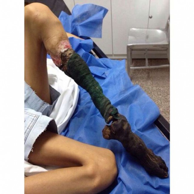 Venezuela, morsa da serpente rischia la vita: foto choc della gamba in necrosi