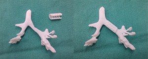 La prima trachea creata con stampante 3D usando cellule umane