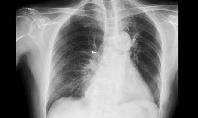 Vite nel polmone, radiografia la scopre per caso FOTO