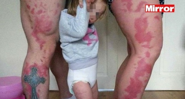 GB, si tatuano la voglia color fragola della figlia sulle gambe FOTO
