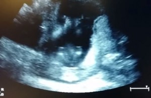 VIDEO YouTube: feto batte le mani a tempo di musica durante ecografia