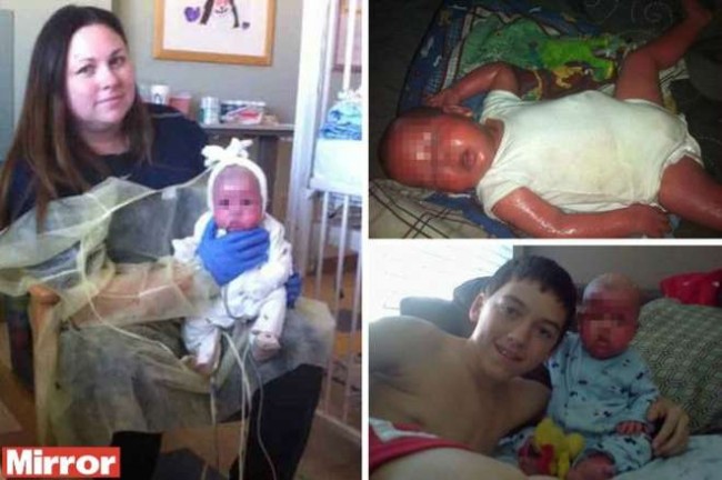 Mamma denunciata per aver ustionato figlio, ma il piccolo soffre di una malattia rar