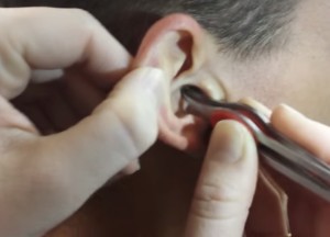 VIDEO YouTube - Non sente da un orecchio: tappo di cerume di alcuni cm