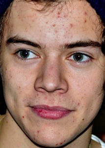 Harry Styles, idolo degli adolescenti, soffre di acne