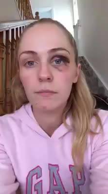 VIDEO Youtube: Emma Murphy, blogger si mostra con lividi: "Lasciate i violenti"