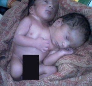 FOTO Bambino con 2 teste nasce in India, muore dopo 24 ore