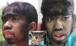 Bangladesh, la "bambina lupo": 12 anni, coperta di peli
