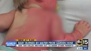 Madre fa bagnetto a figlio con tubo acqua giardino: ustionato 