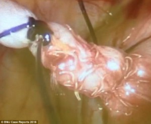 YOUTUBE: sospetta appendicite ma in pancia aveva centinaia di vermi