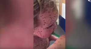 YOUTUBE Jasper Allen, 2 anni, ha la peggiore varicella di sempre