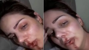 YOUTUBE Renata Lustosa picchiata da ex marito, la modella brasiliana posta video