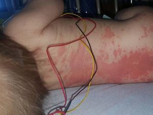 Bimbo di 4 mesi ha puntini rossi sulla pelle: così la mamma scopre la meningite