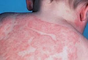 Crema contro eczema a base di paraffina: 10 persone morte bruciate