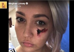 Meghan Linsey, morsa dal ragno violino: "Ho rischiato di perdere un occhio" FOTO