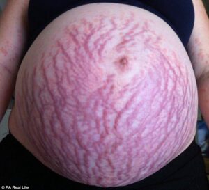 Si riempie di macchie rosse in gravidanza: era allergica al feto